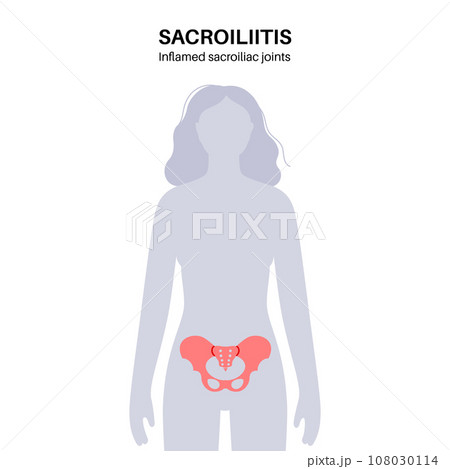 Sacroiliitis medical poster Sacroiliitis medical poster 108030114