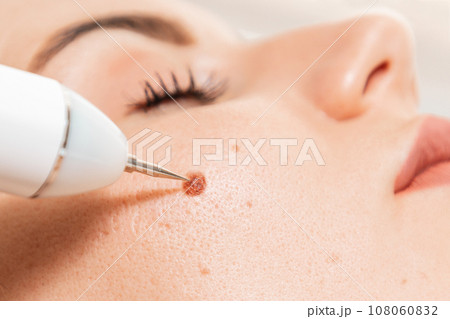 Microsurgery. Removal of birthmark from client's cheek with laser device. Close up. Concept of laser cosmelotogy and electrocoagulation Microsurgery. Removal of birthmark from client's cheek with laser device. Close up. Concept of laser cosmelotogy and electrocoagulation 108060832