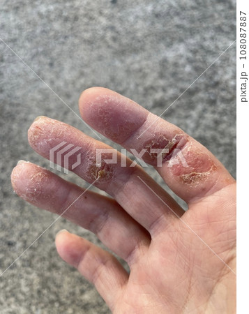 アトピー性皮膚炎患者の、ペットアレルギーと汗疱疹の悪化による皮膚の裂け、手湿疹・手荒れ、自己免疫疾患 アトピー性皮膚炎患者の、ペットアレルギーと汗疱疹の悪化による皮膚の裂け、手湿疹・手荒れ、自己免疫疾患 108087887