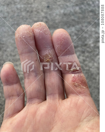 アトピー性皮膚炎患者の、ペットアレルギーと汗疱疹の悪化による皮膚の裂け、手湿疹・手荒れ、自己免疫疾患 アトピー性皮膚炎患者の、ペットアレルギーと汗疱疹の悪化による皮膚の裂け、手湿疹・手荒れ、自己免疫疾患 108087888