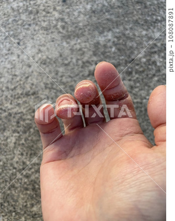 アトピー性皮膚炎患者の、ペットアレルギーと汗疱疹の悪化による皮膚の裂け、手湿疹・手荒れ、自己免疫疾患 108087891