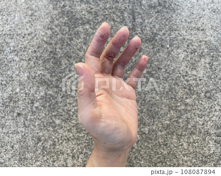 アトピー性皮膚炎患者の、ペットアレルギーと汗疱疹の悪化による皮膚の裂け、手湿疹・手荒れ、自己免疫疾患 アトピー性皮膚炎患者の、ペットアレルギーと汗疱疹の悪化による皮膚の裂け、手湿疹・手荒れ、自己免疫疾患 108087894