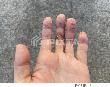 アトピー性皮膚炎患者の、ペットアレルギーと汗疱疹の悪化による皮膚の裂け、手湿疹・手荒れ、自己免疫疾患 アトピー性皮膚炎患者の、ペットアレルギーと汗疱疹の悪化による皮膚の裂け、手湿疹・手荒れ、自己免疫疾患 108087895