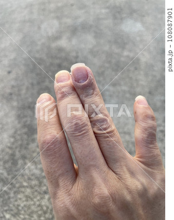 アトピー性皮膚炎患者の、ペットアレルギーと汗疱疹の悪化による皮膚の裂け、手湿疹・手荒れ、自己免疫疾患 108087901