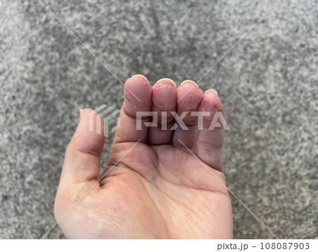 アトピー性皮膚炎患者の、ペットアレルギーと汗疱疹の悪化による皮膚の裂け、手湿疹・手荒れ、自己免疫疾患 108087903