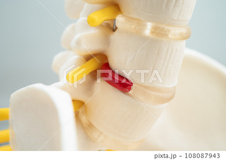 Lumbar spine displaced herniated disc fragment, spinal nerve and bone. Model for treatment medical in the orthopedic department. 108087943