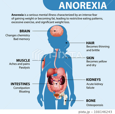 Informative poster of Anorexia eating disorder 108146243