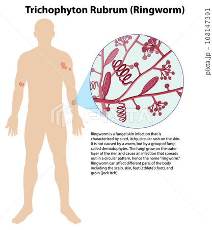 Trichophyton Rubrum fungal infection Trichophyton Rubrum fungal infection 108147391
