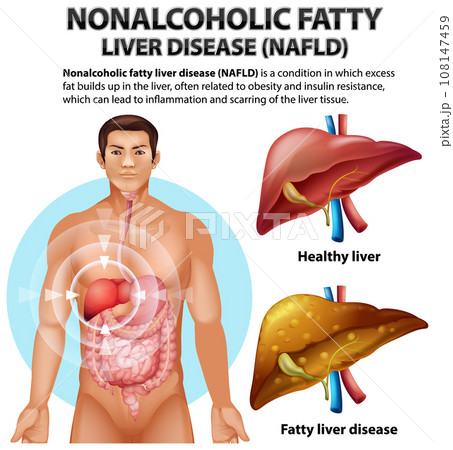 Nonalcoholic Fatty Liver Disease 108147459