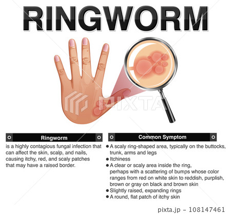 Informative symptoms of Ringworm Informative symptoms of Ringworm 108147461