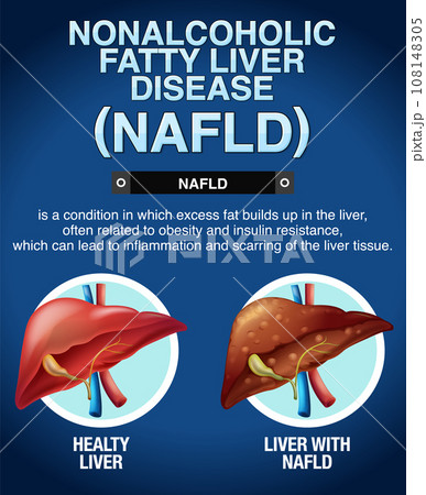 Nonalcoholic fatty liver disease 108148305