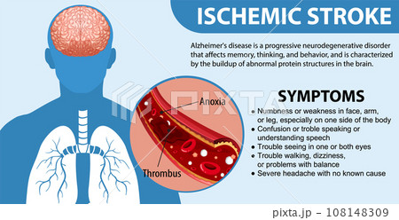 Informative poster of Ischemic stroke 108148309