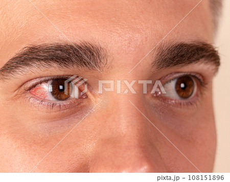 Red and inflamed eye close-up. Patient's red eye. Allergic reaction Red and inflamed eye close-up. Patient's red eye. Allergic reaction 108151896