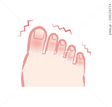 しもやけ・凍瘡で痒そうな足の指のイラスト 108156714