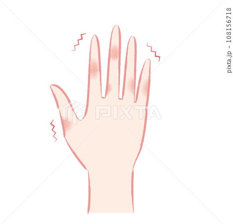 しもやけ(凍瘡)で痒そうな手・指先のイラスト 108156718