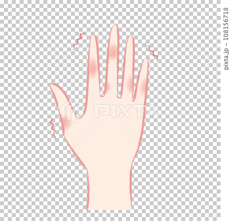 しもやけ(凍瘡)で痒そうな手・指先のイラスト 108156718