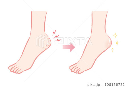 ガサガサかかと　つるつるかかと　ビフォーアフターのイラスト 108156722