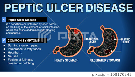 Peptic Ulcer Disease Explained Infographic Peptic Ulcer Disease Explained Infographic 108170243