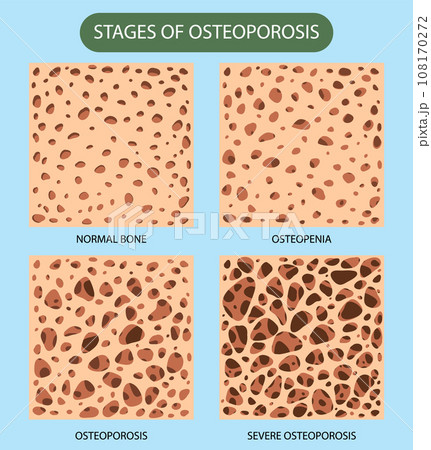 Bone Density and Osteoporosis Vector 108170272