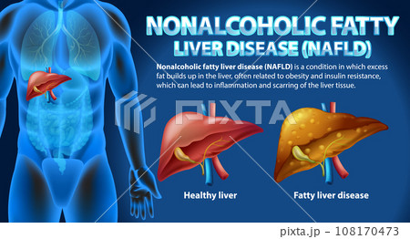 Nonalcoholic Fatty Liver Disease (NAFLD) Nonalcoholic Fatty Liver Disease (NAFLD) 108170473