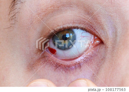 Close up of a bloodshot eye man. Hemorrhage of the eye, rupture of a vessel in the eye, blood in the eye 108177563