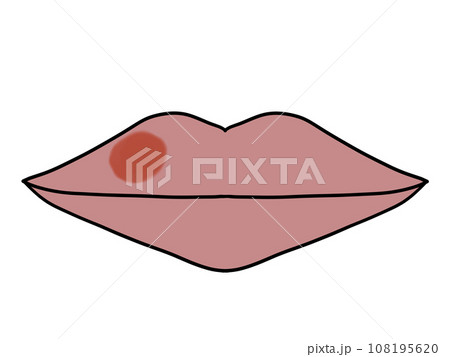 口唇ヘルペス(発症) 口唇ヘルペス(発症) 108195620