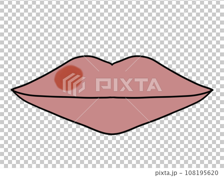 口唇ヘルペス(発症) 口唇ヘルペス(発症) 108195620