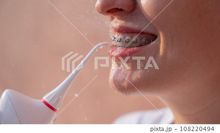 A woman with braces on her teeth uses an irrigator. Close-up portrait. A woman with braces on her teeth uses an irrigator. Close-up portrait. 108220494