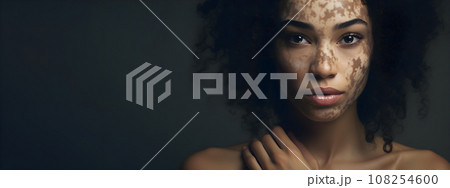 woman with vitiligo condition 108254600