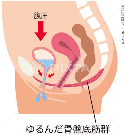 ゆるんでいる骨盤底筋と排尿の仕組み 尿もれ 健康 ゆるんでいる骨盤底筋と排尿の仕組み 尿もれ 健康 108267716