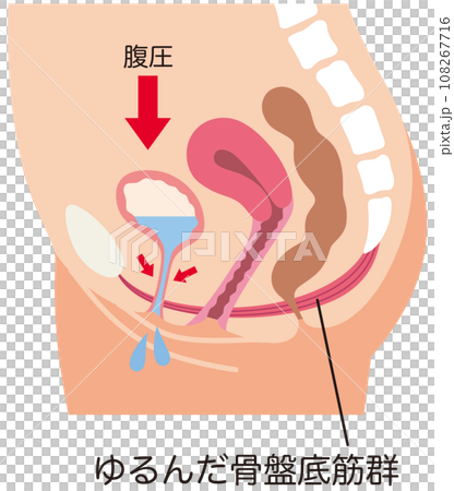 ゆるんでいる骨盤底筋と排尿の仕組み 尿もれ 健康 ゆるんでいる骨盤底筋と排尿の仕組み 尿もれ 健康 108267716