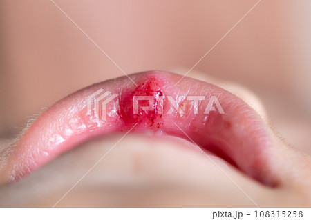 Little boy with injury on his lip. 108315258