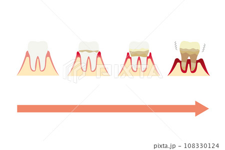 歯周病が進行する図解イラスト 108330124