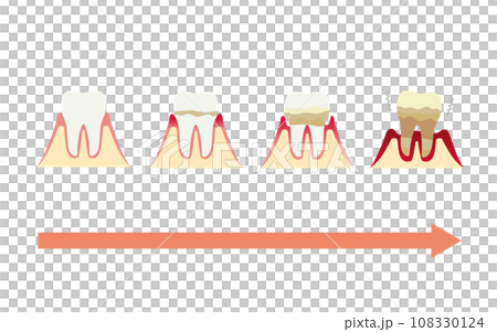 歯周病が進行する図解イラスト 108330124