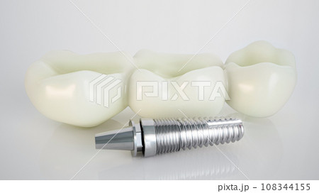 Dental Implant: Modern Solution for Tooth Replacement 108344155