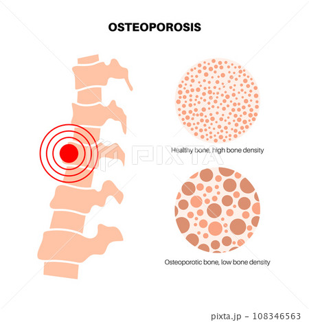 Osteoporosis medical poster Osteoporosis medical poster 108346563