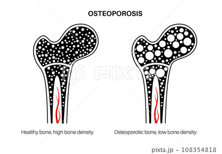 Osteoporosis medical poster Osteoporosis medical poster 108354818