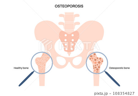 Osteoporosis medical poster Osteoporosis medical poster 108354827