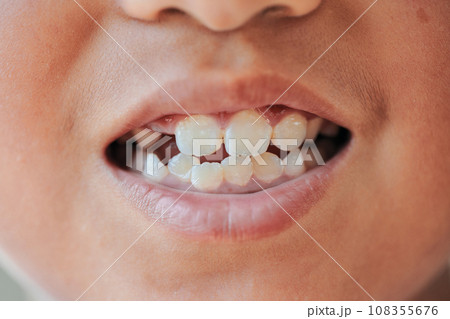 小学3年男の子の歯 108355676