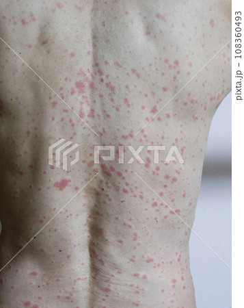 薬疹 108360493