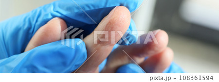 Doctor in rubber gloves examines patient fingers with eczema Doctor in rubber gloves examines patient fingers with eczema 108361594