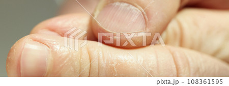 Patient shows eczema on fingers caring about skin health Patient shows eczema on fingers caring about skin health 108361595