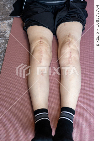 膝の人工関節手術をした後の女性の足の傷跡 108375704