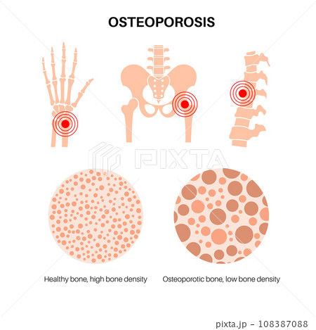 Osteoporosis medical poster 108387088