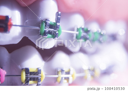 Metal teeth brackets Metal teeth brackets 108410530