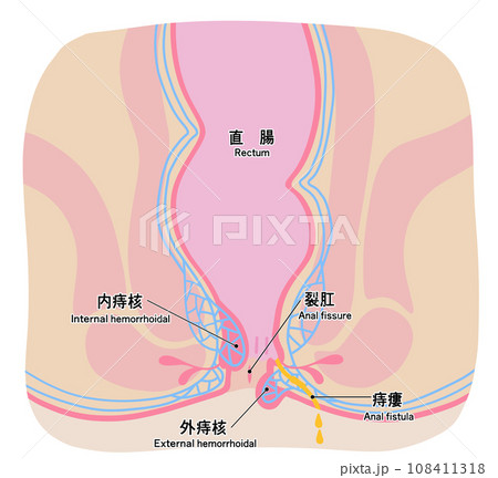 肛門周りの痔のシンプルなイラスト 108411318