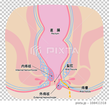 肛門周りの痔のシンプルなイラスト 108411318