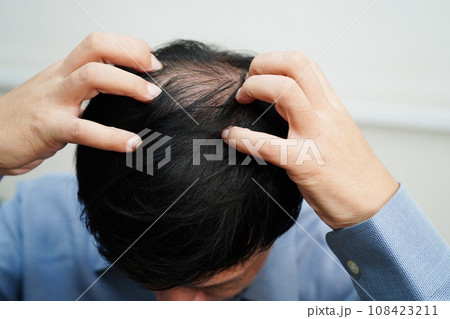 Bald head in man, hair loss treatment health problem. 108423211
