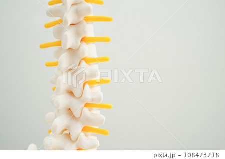 Spinal nerve and bone, Lumbar spine displaced herniated disc fragment, Model for treatment medical in the orthopedic department. 108423218