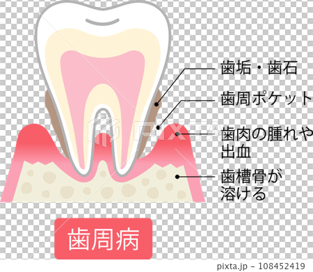 Periodontal disease cross section 108452419